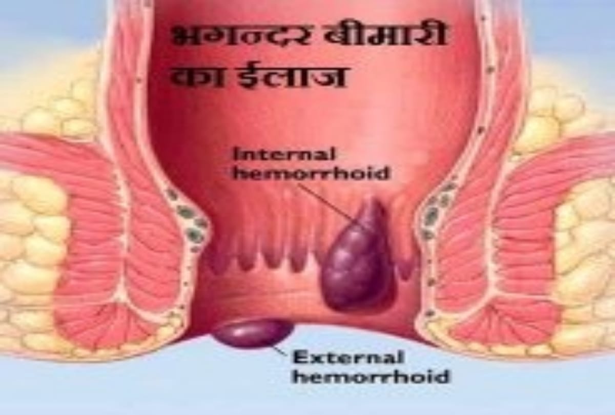 Fistula causes symptoms Prevention and treatment Surgery