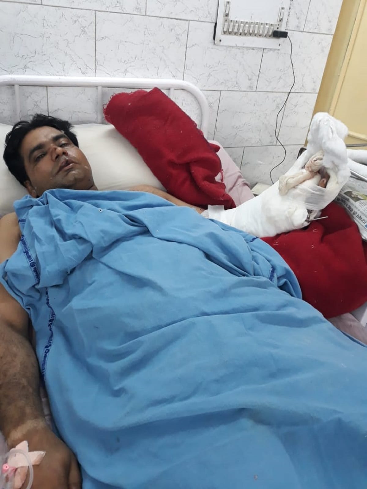 Safdarjung hopital doctors did split arm surgery, gave new life