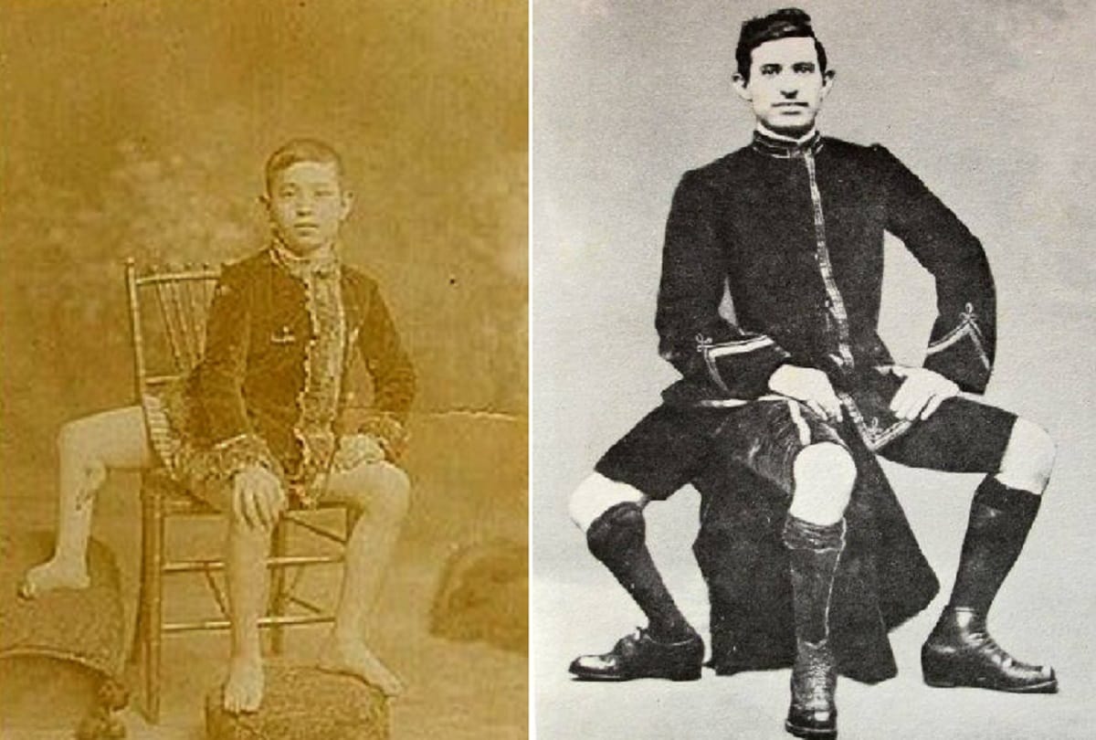 Three legged man Frank Lentini Interesting story of a Strange person