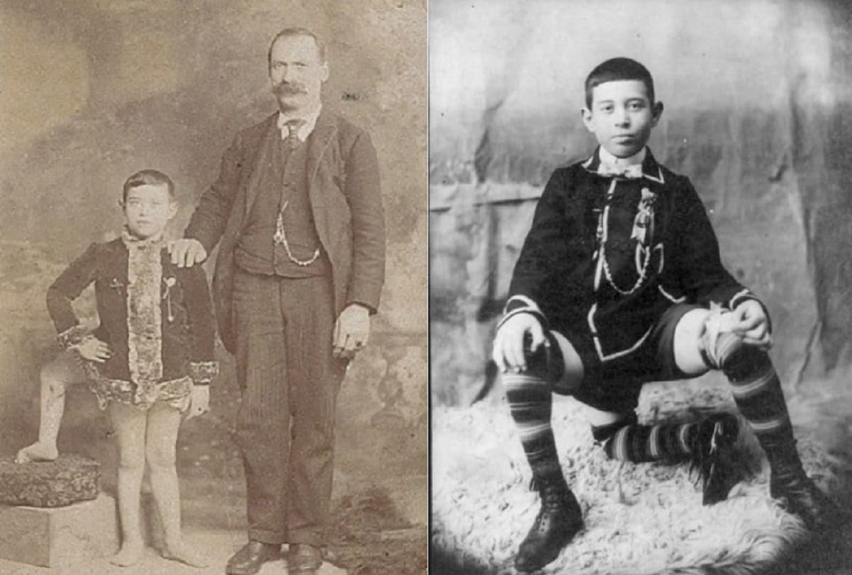 Three legged man Frank Lentini Interesting story of a Strange person