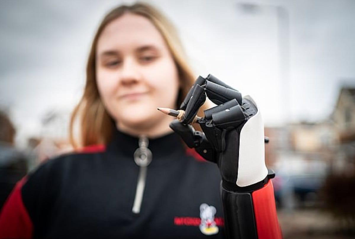 Aimee Ashton of Britain with worlds first medically certified 3D printed bionic hand