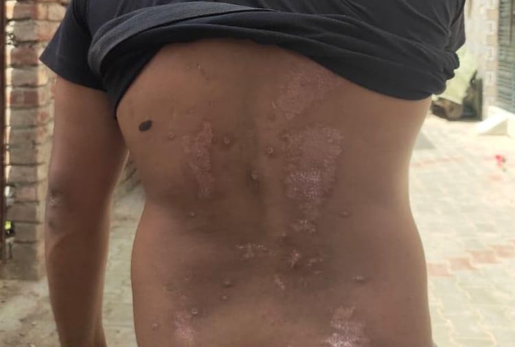 Burnt employee's back after by falling Sodium hypochlorite