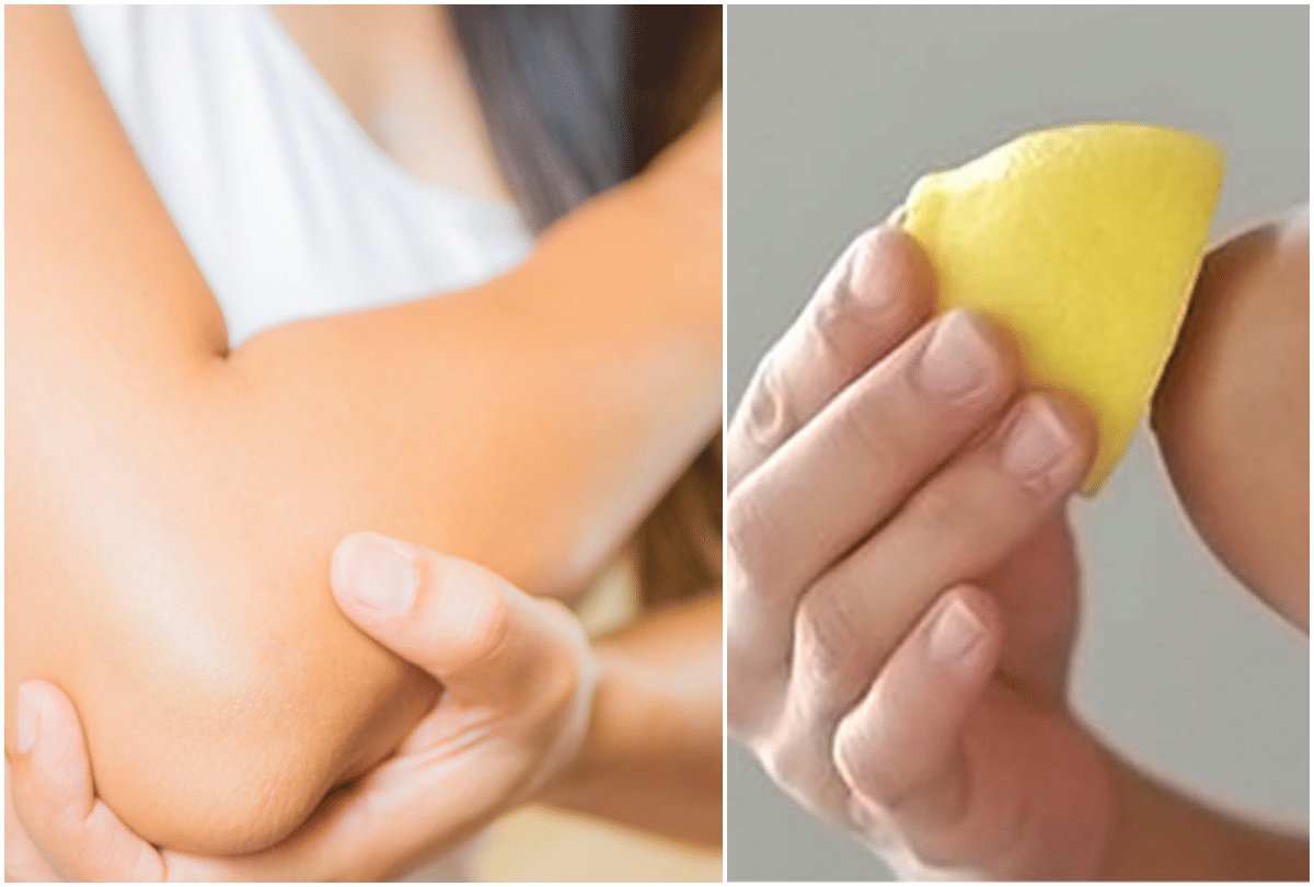 4 ways to get rid of dark elbows overnight
