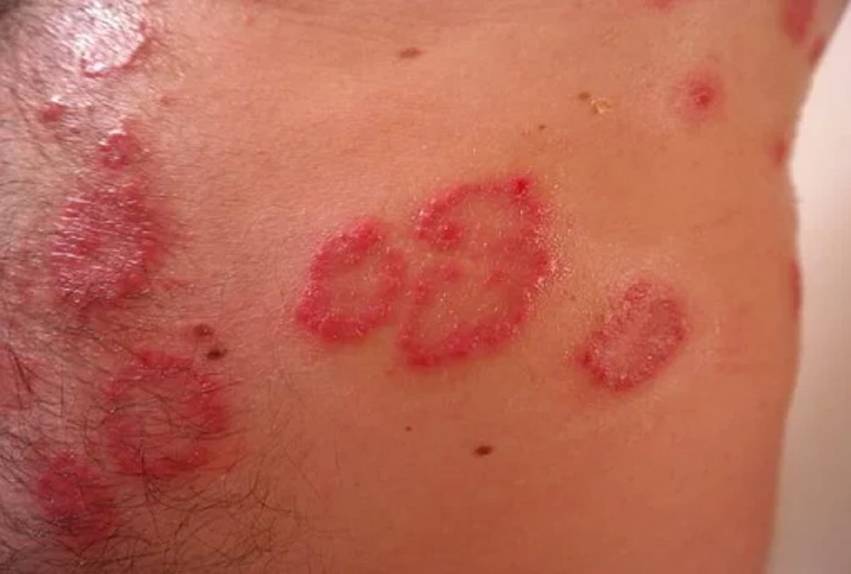 autoimmune progesterone dermatitis during periods, know its symptoms and causes