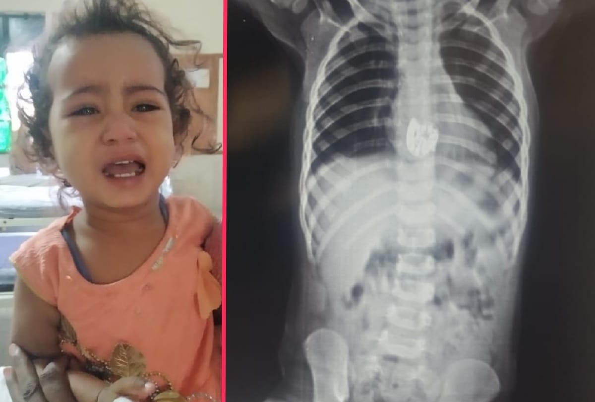 Doctors saved life of three year old child by operation in BRD Medical College gorakhpur