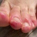 Rashes