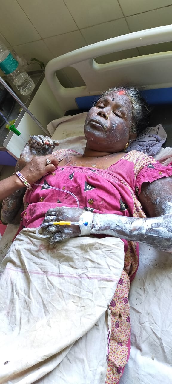Fire broke out due to gas cylinder pipe burst, four people screeching and ambulance did not reach for hours