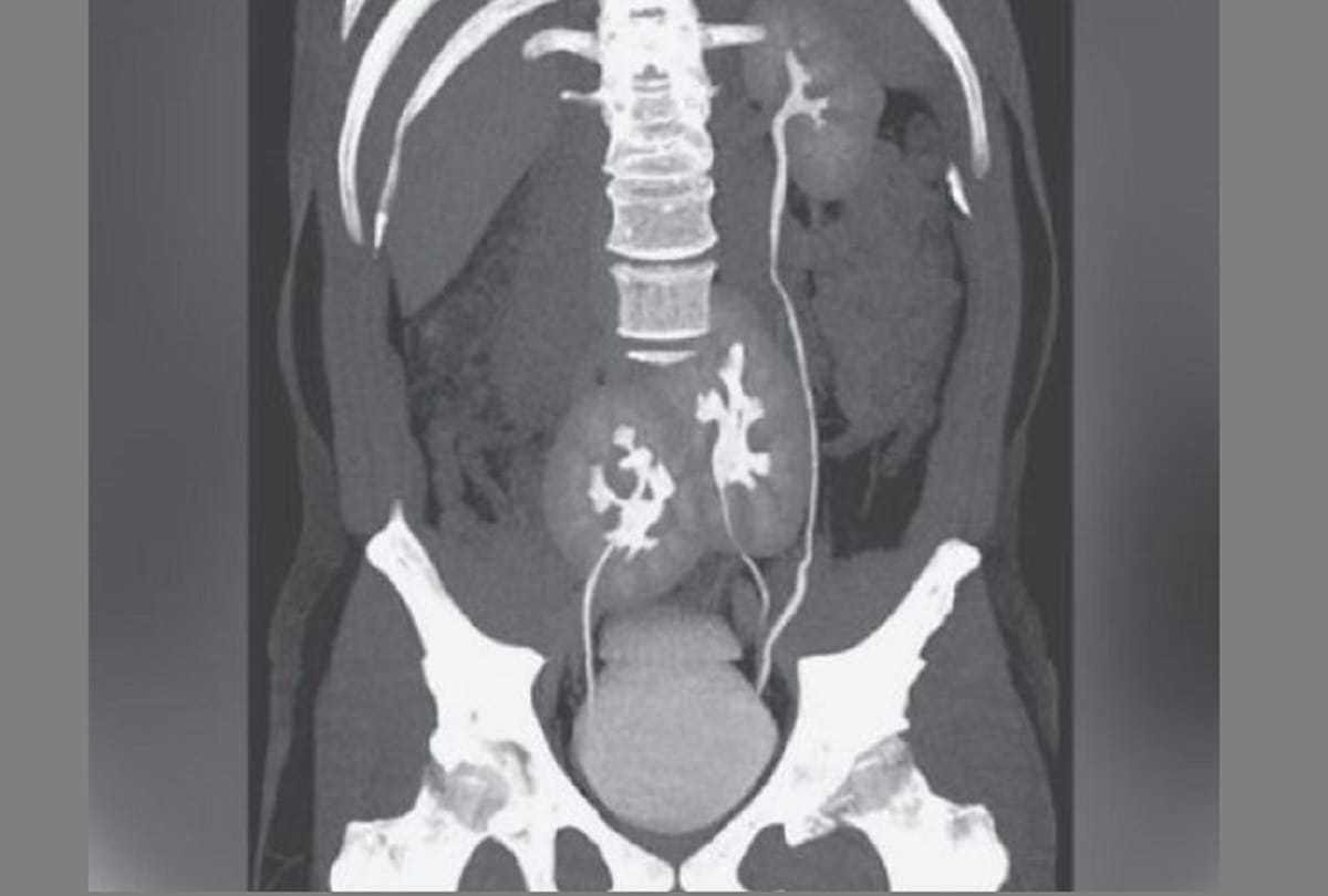 Doctor find third kidney in man after back pain medically surprised to discover that he has 3 kidneys
