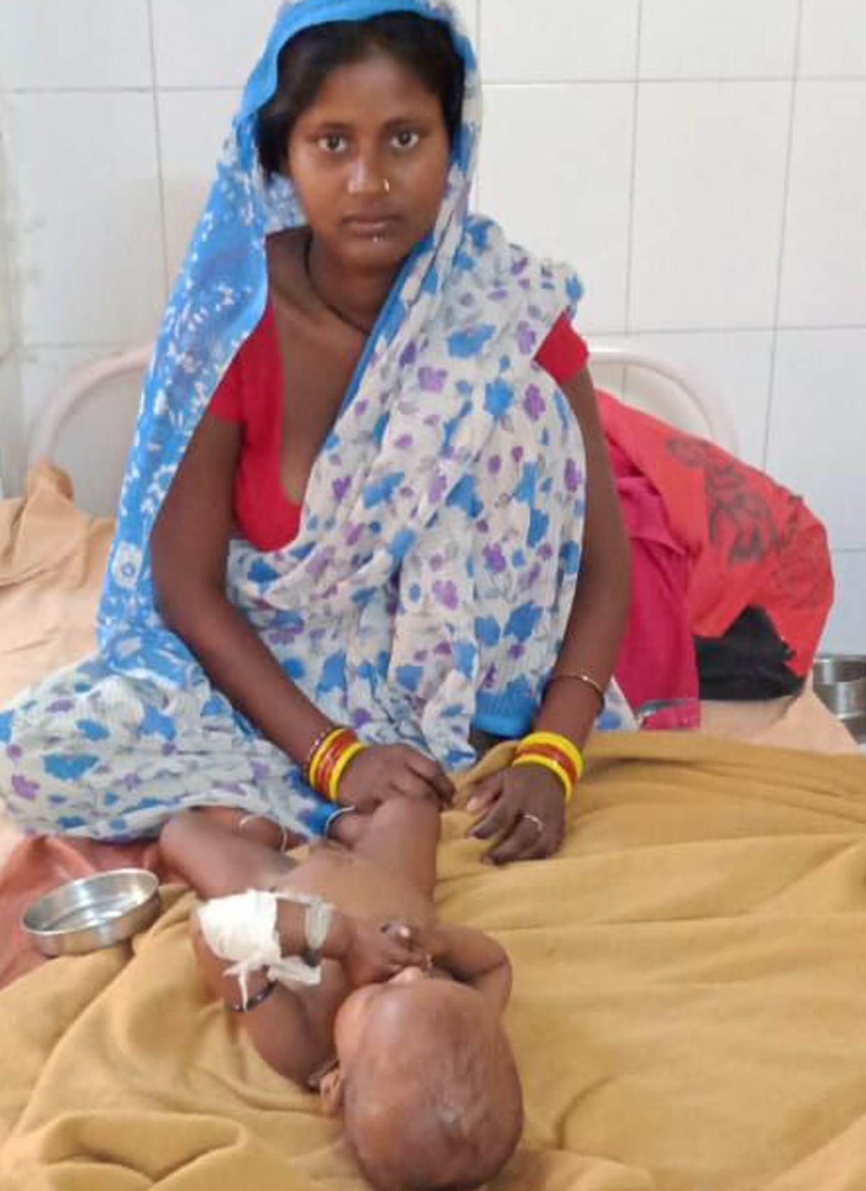 Malnutrition children are more vulnerable to corona