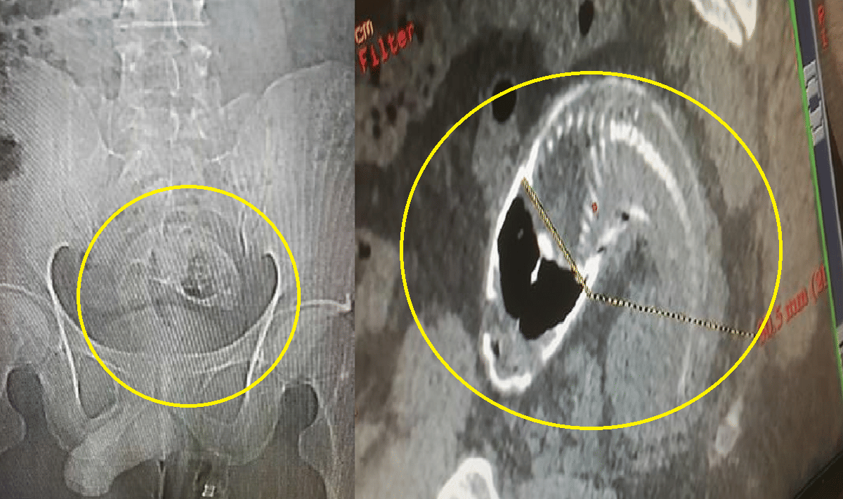 A fish about 16 inches long entered the man's rectum, doctors performed the operation, people were shocked to see the video