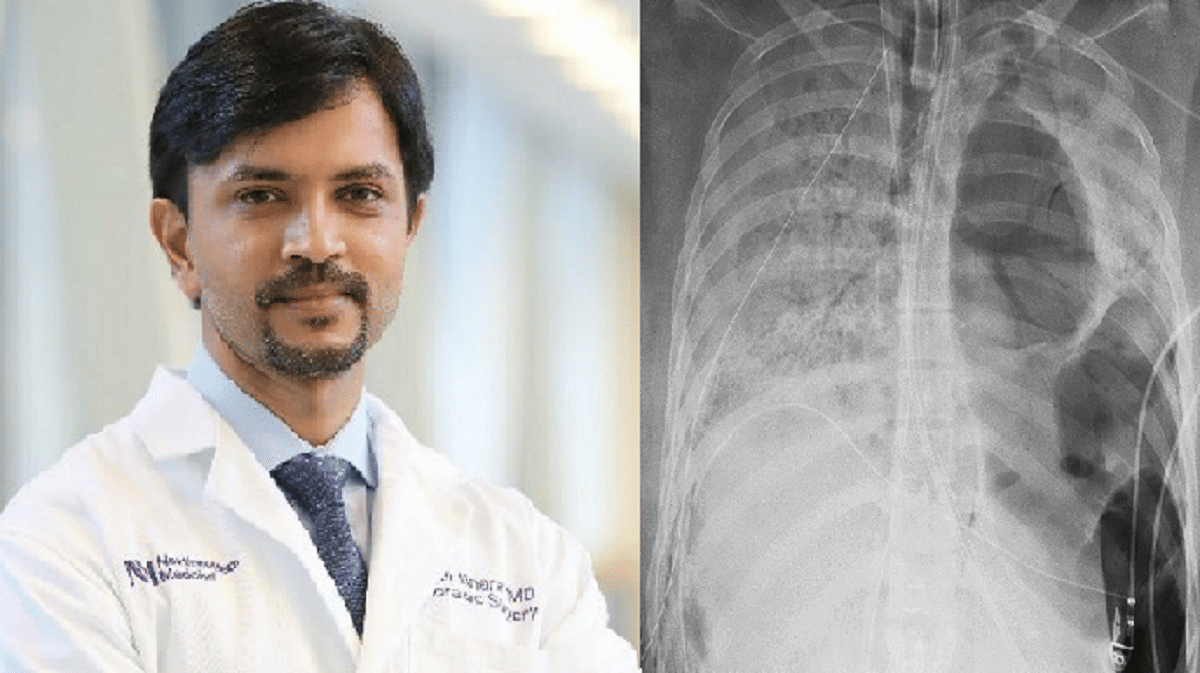Indian-origin doctor Ankit Bharat successfully transplanted both lungs of a corona patient