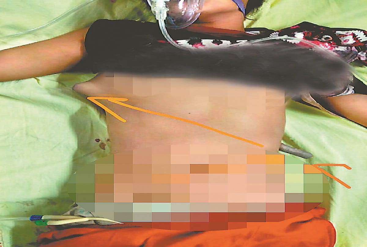 Prayagraj: Two feet stick inserted in teenager's stomach, doctors saved