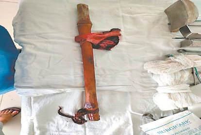Prayagraj: Two feet stick inserted in teenager's stomach, doctors saved