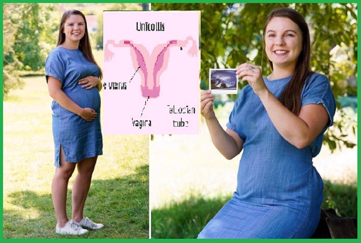 Double Uterus found in pregnant woman in UK, know how it happens