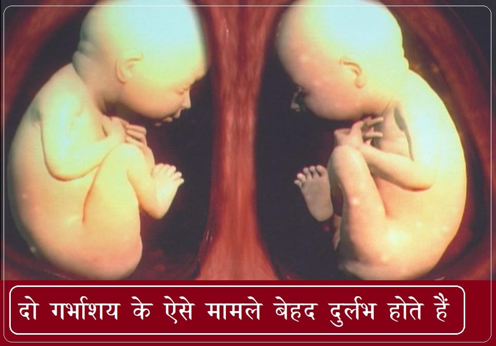 Double Uterus found in pregnant woman in UK, know how it happens