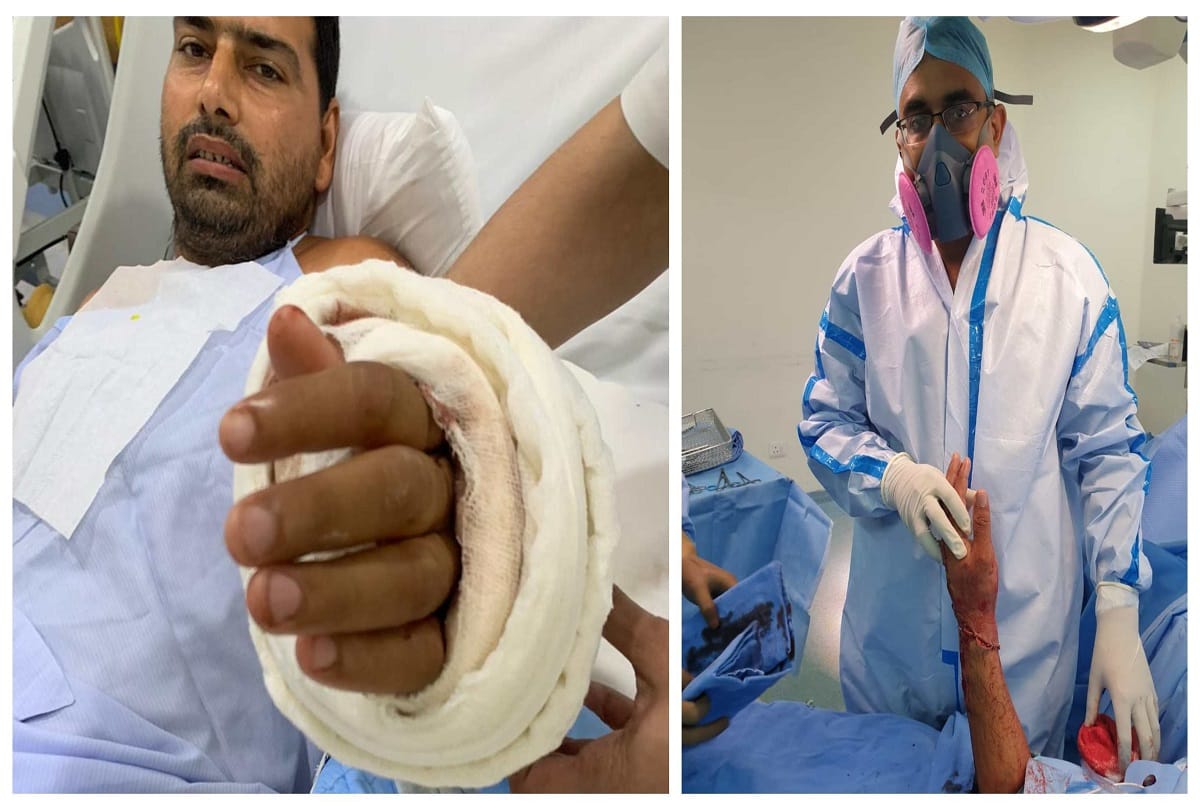 noida doctors join palm with hand again after 9 hours of surgery jaypee hospital