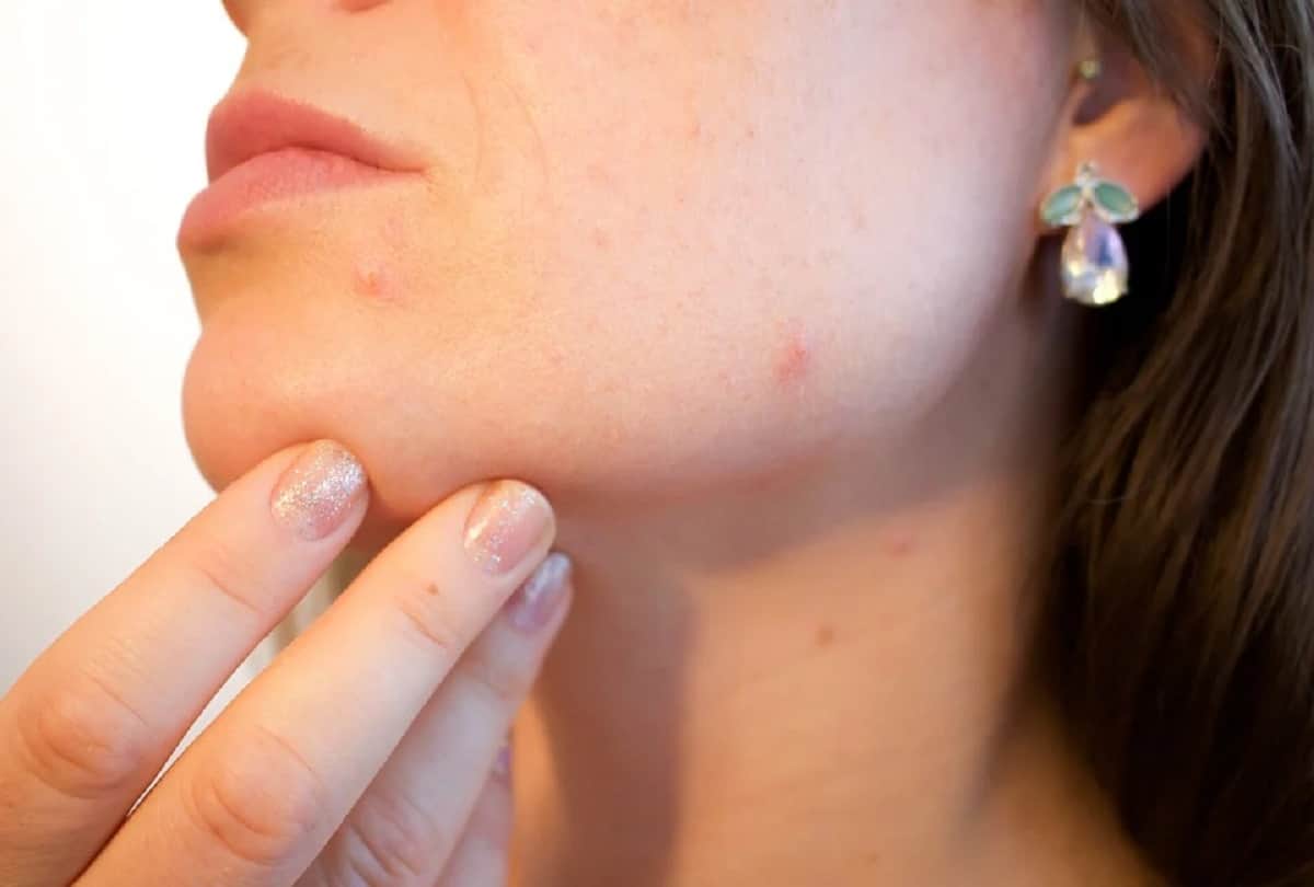 These remedies will make your oily face healthy clear and shiny