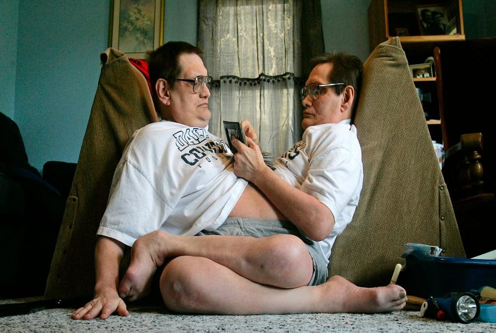 Worlds longest-surviving conjoined twins die at 68