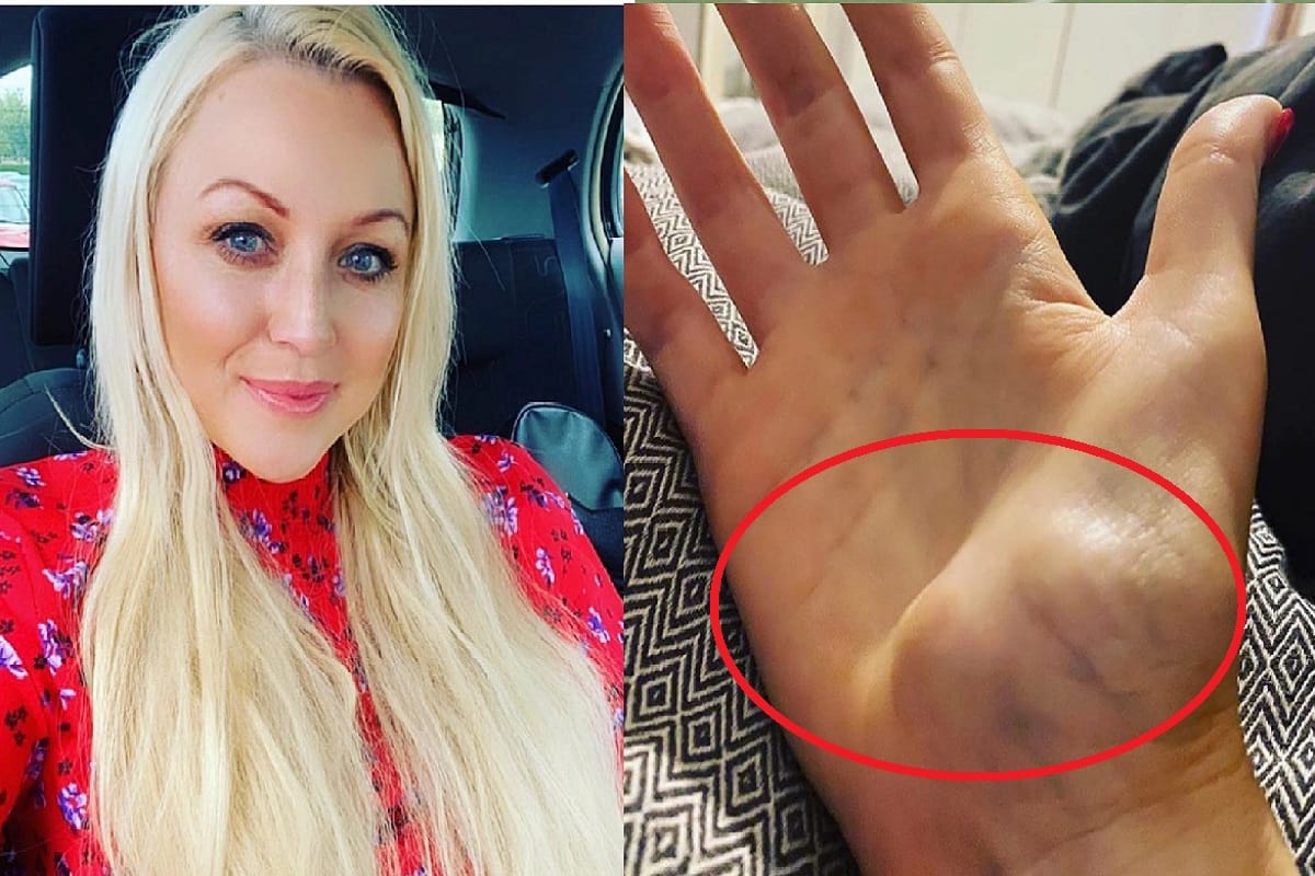 After to much texting from mobile gave me lumps in my right hand and ended up having to have it amputated
