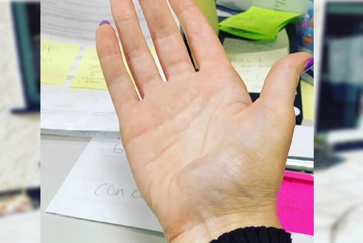 right hand amputated