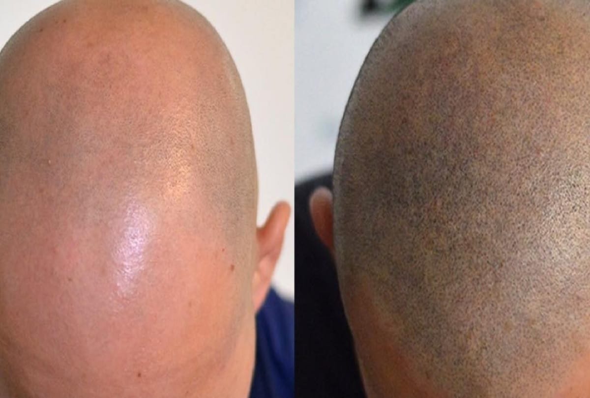 Coronavirus study claims baldness is a risk factor for Covid-19 Men who have completely lost hair are 40% more likely to end up in hospital