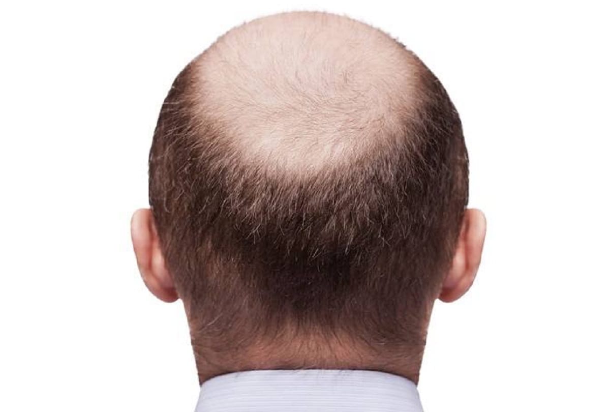 Scientists have discovered TGF-beta  that may lead to the effective treatment of baldness