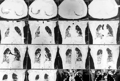 people died due to respiratory system failure in coronavirus disease