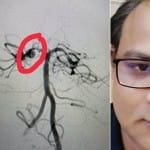 ऑपरेशन से पहले चित्र में दिखाई गई फटी नस (बायें) व डॉ कुलदीप यादव