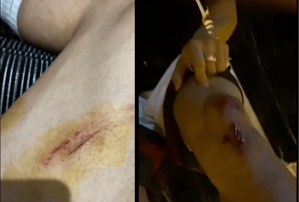 Asim Riaz Attack News: bigg boss ex contestant Asim Riaz injured in accident hit by bike rider