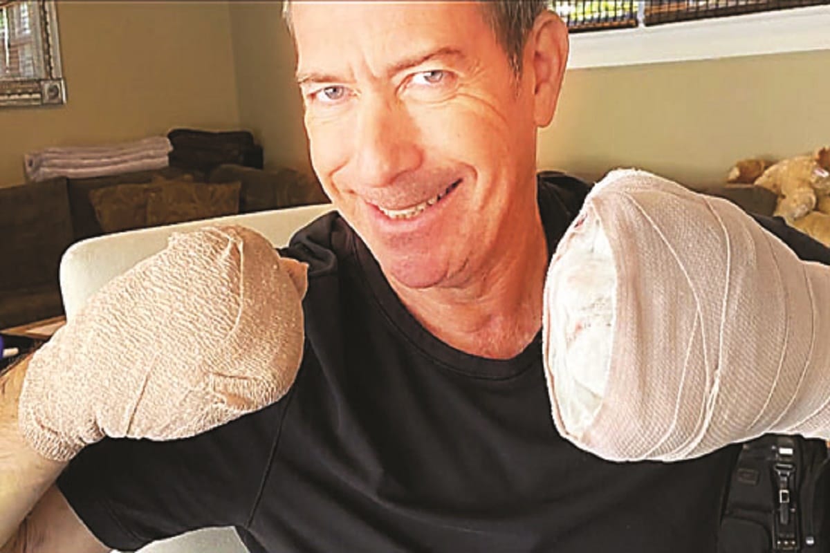 COVID-19 survivor Gregg Garfield loses fingers after complications from disease