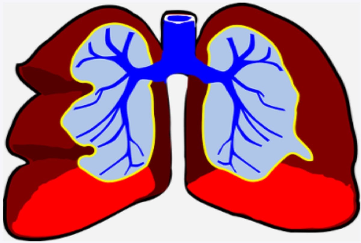Coronavirus lungs problems know What happens to your lungs when you get covid 19 infection