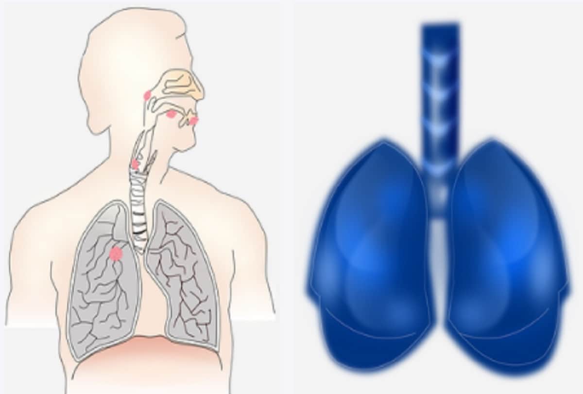 sanjay dutt is suffering from third stage advanced lung cancer symptoms causes and treatment