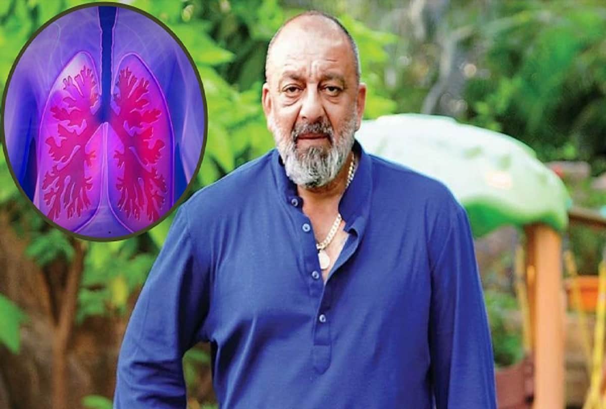 sanjay dutt is suffering from third stage advanced lung cancer symptoms causes and treatment