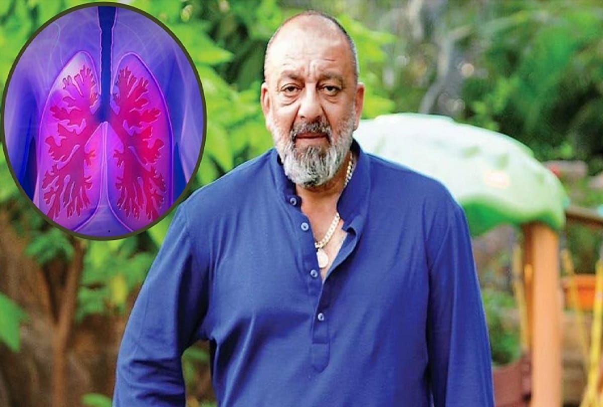 sanjay dutt is suffering from third stage advanced lung cancer symptoms causes and treatment