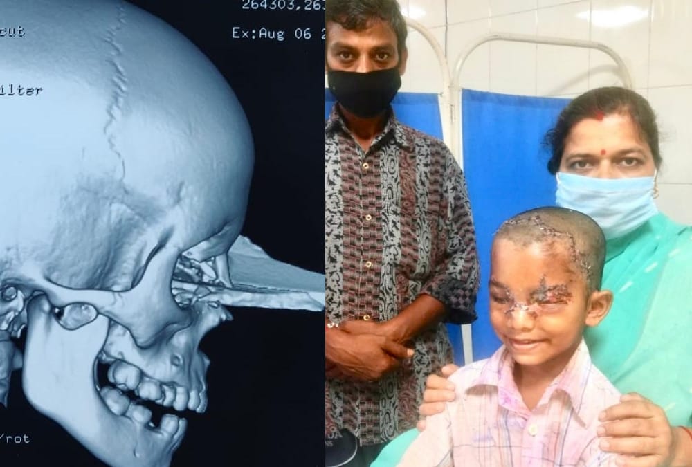 Doctors saved the eye of a child in KGMU.