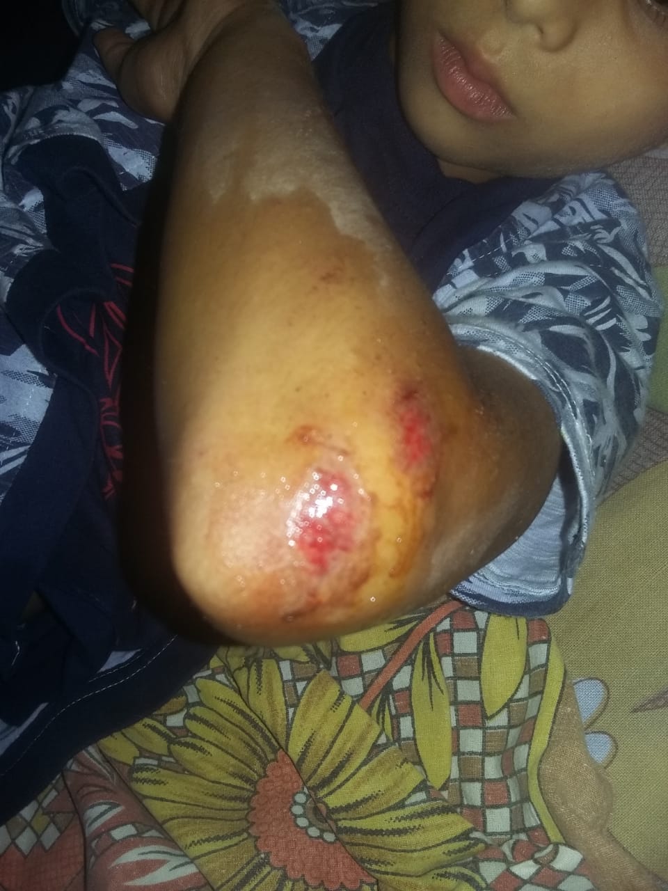 mokey attack on 10 years old girl