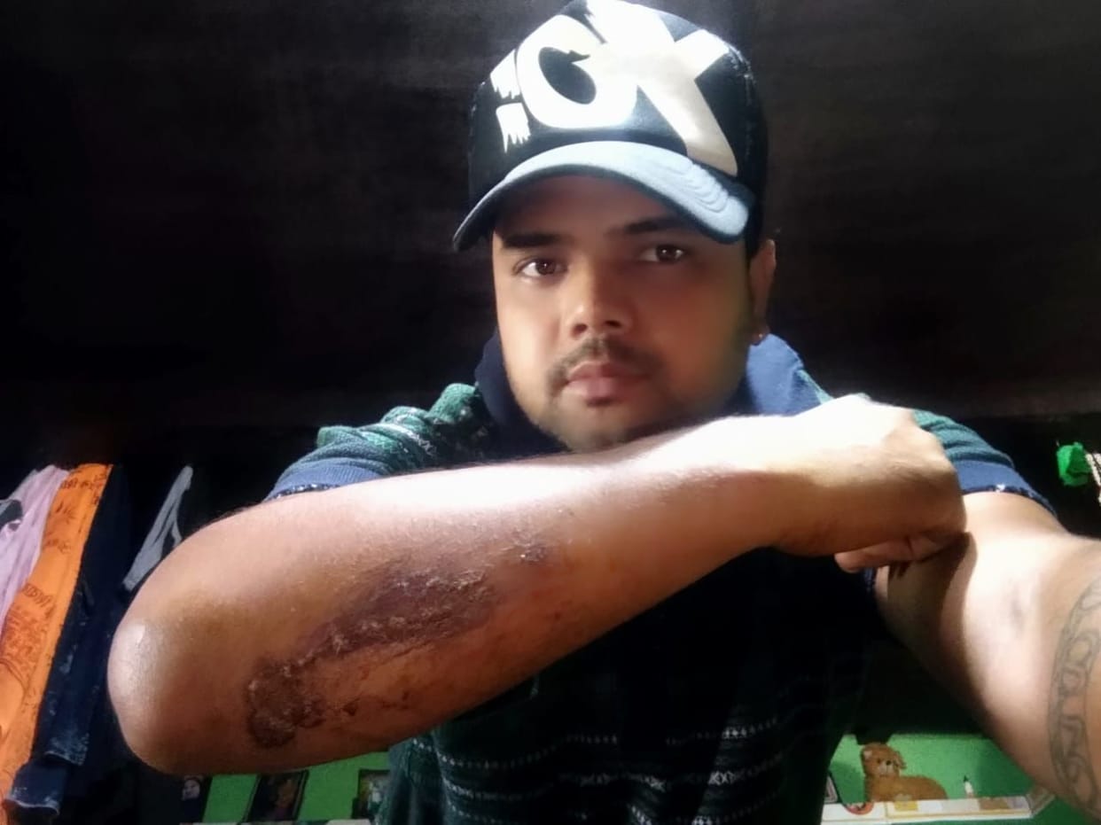 Scooty rider injured by monkey attack