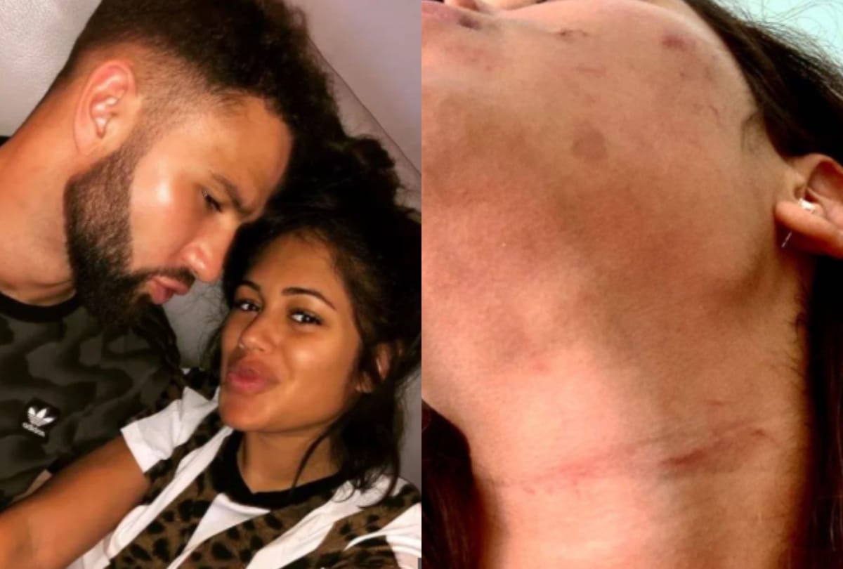 Malin Andersson shares pictures of her injuries after her boyfriend beaten