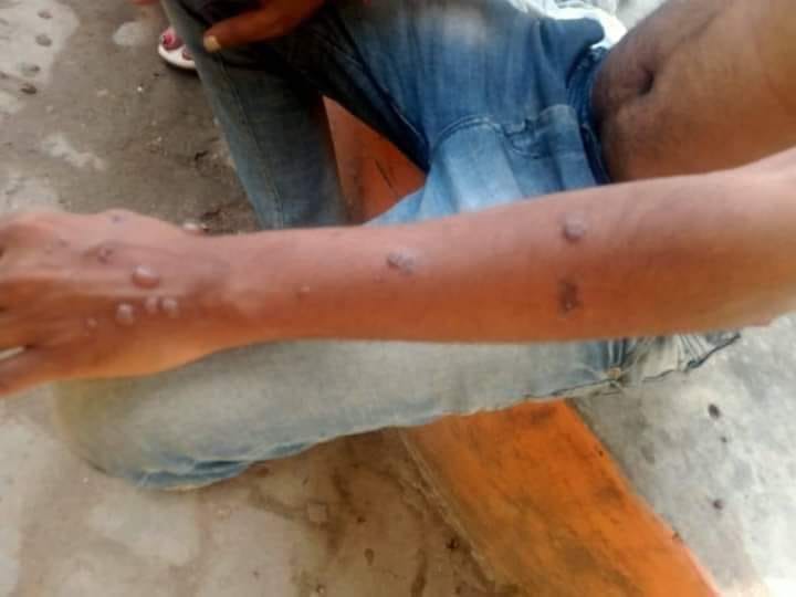 Lover held hostage for 9 days, beaten with cigarette by girl's family member