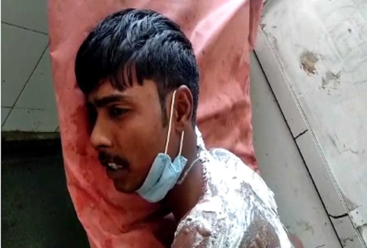 Aligarh man brutally burnt by his neighbour after a normal argument