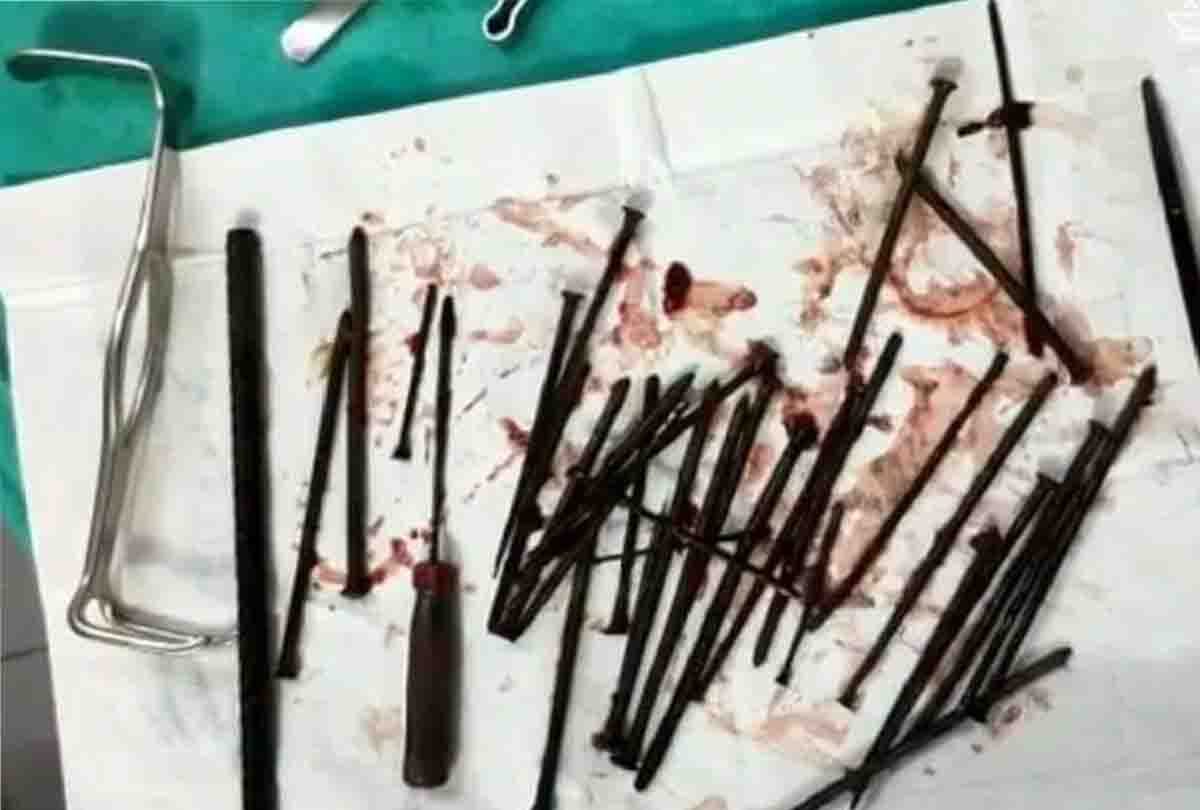 Nails from the stomach, screwdriver, rebar and sand