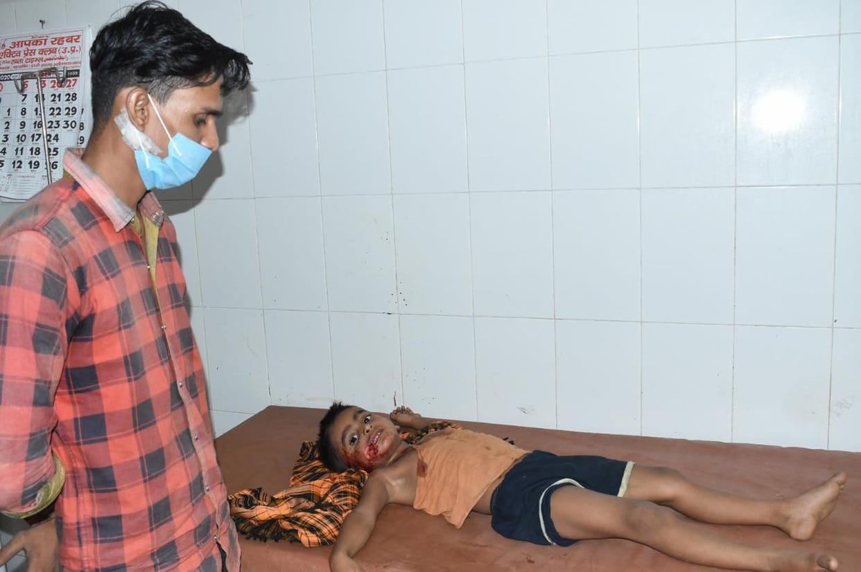 stray dogs bite a 3 years old little child and injured in moradabad