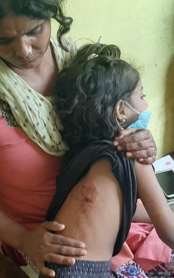 dog bite