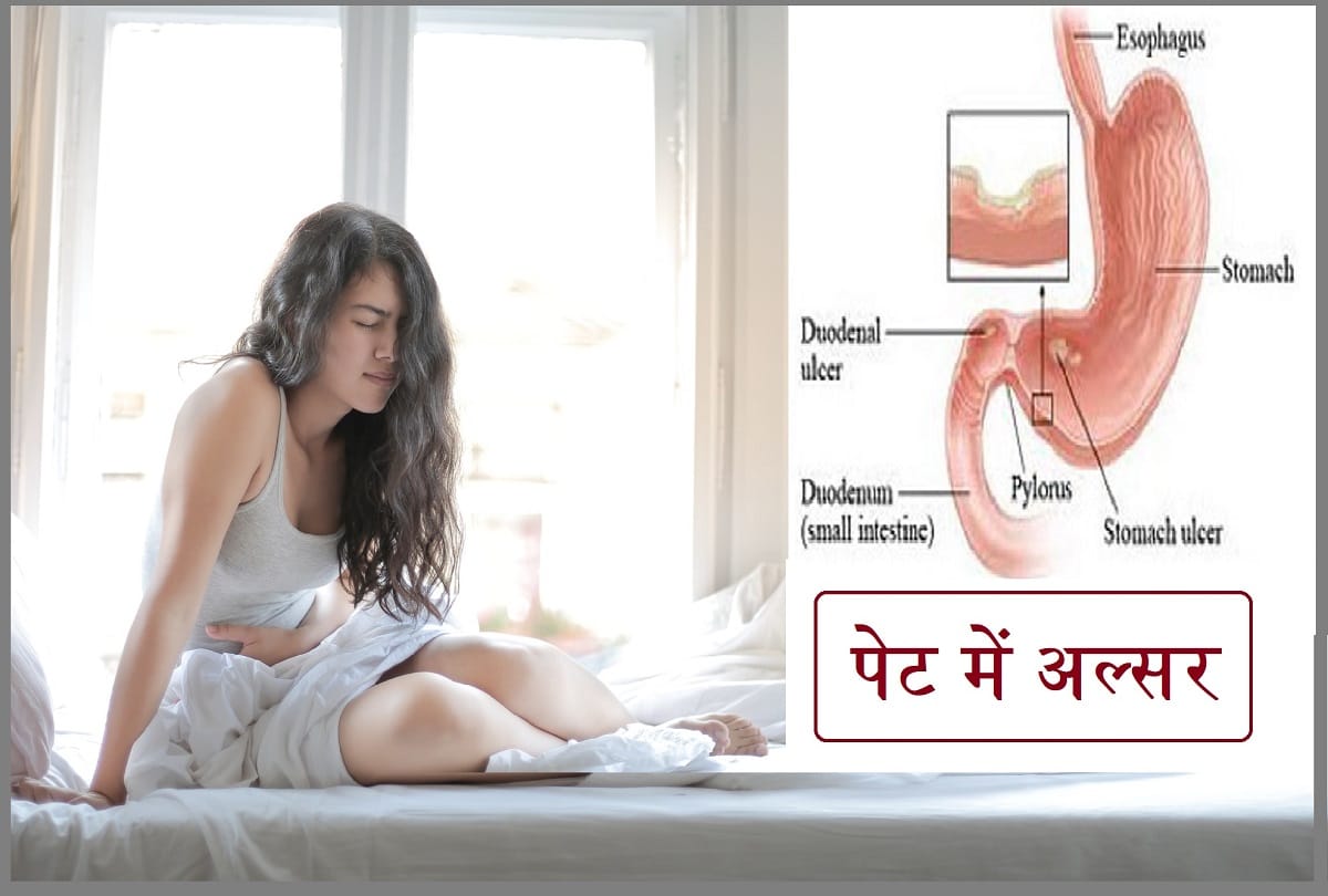 Home Remedies for Stomach Ulcer Symptoms Causes And Treatment in Hindi