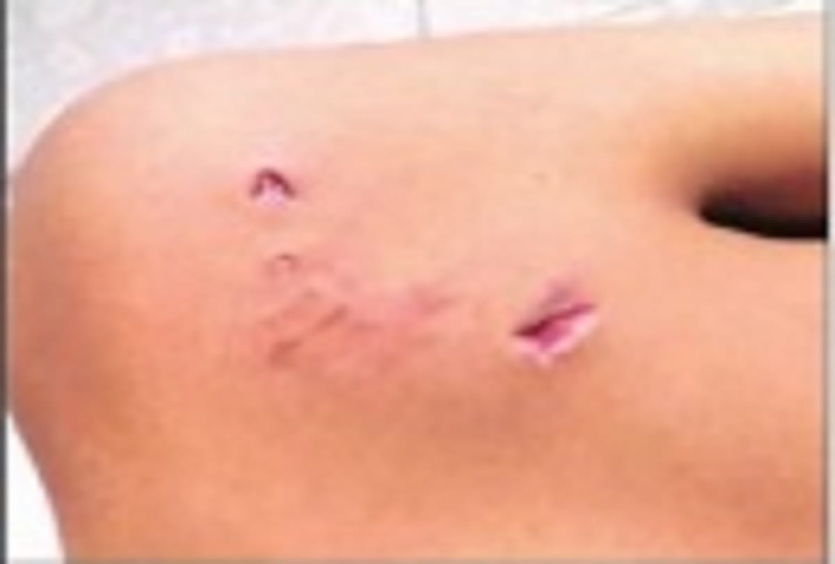 Ghaziabad Indirapuram society girl attacked by dogs badly injured