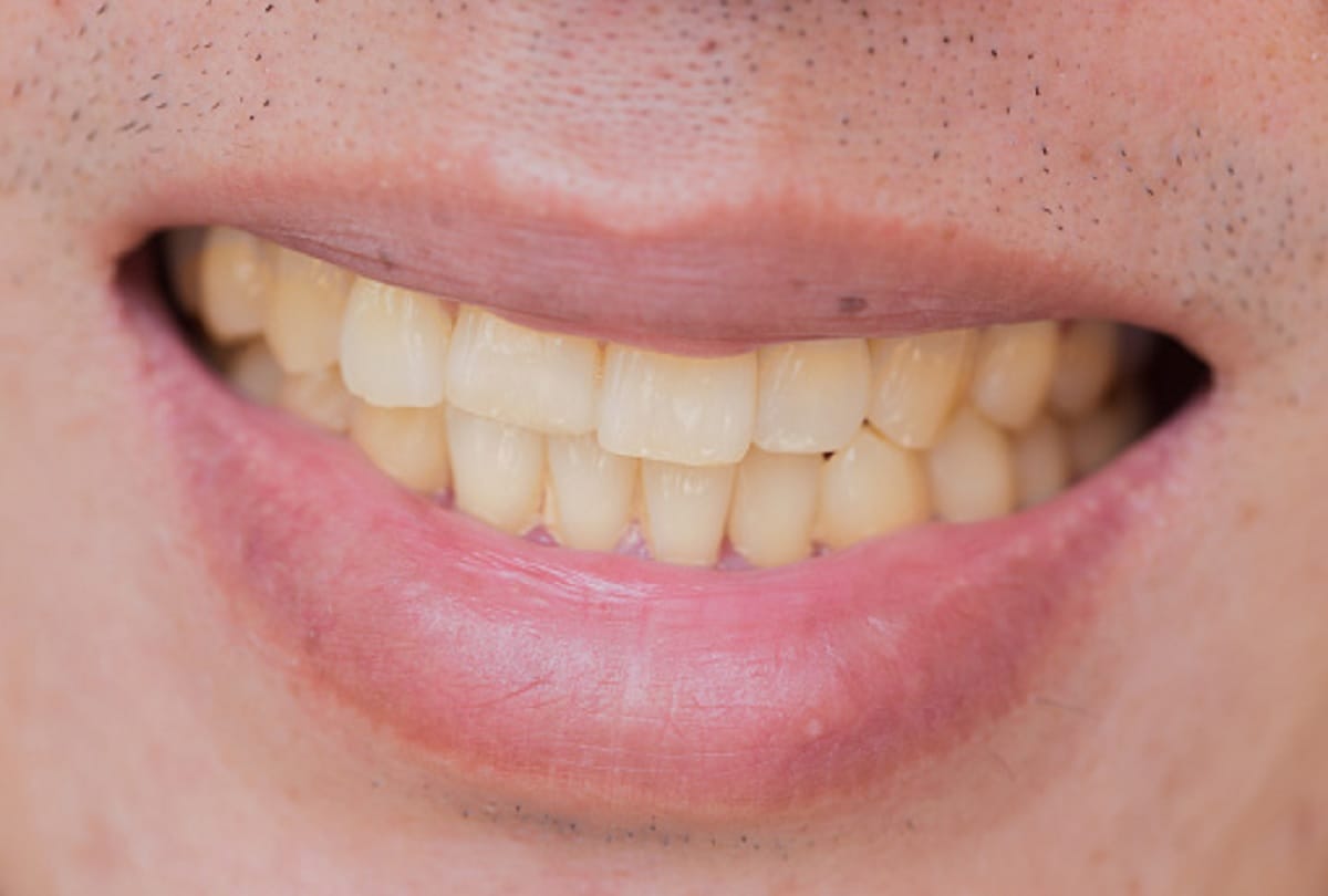 If you eat paan-gutkha your teeth will break