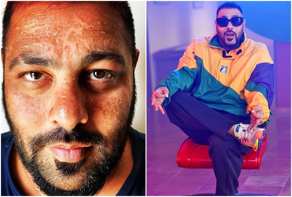 Bollywood Singer Badshah Gets Sunburn While Holidays In Maldives Varun Dhawan Reacted and Said Same