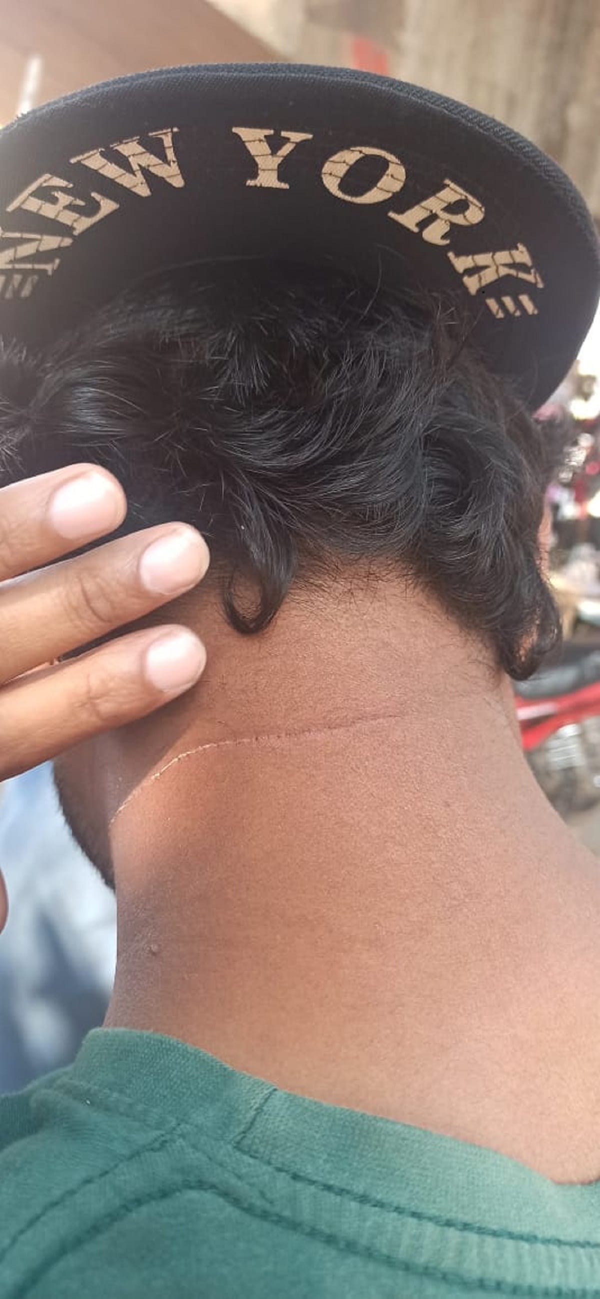 Chinese Manjha cut neck of man treatment done in hospital in varanasi