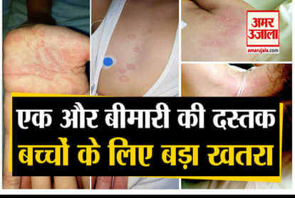 SARSCoV2 causes Kawasaki like disease in children COVID-19 ICMR