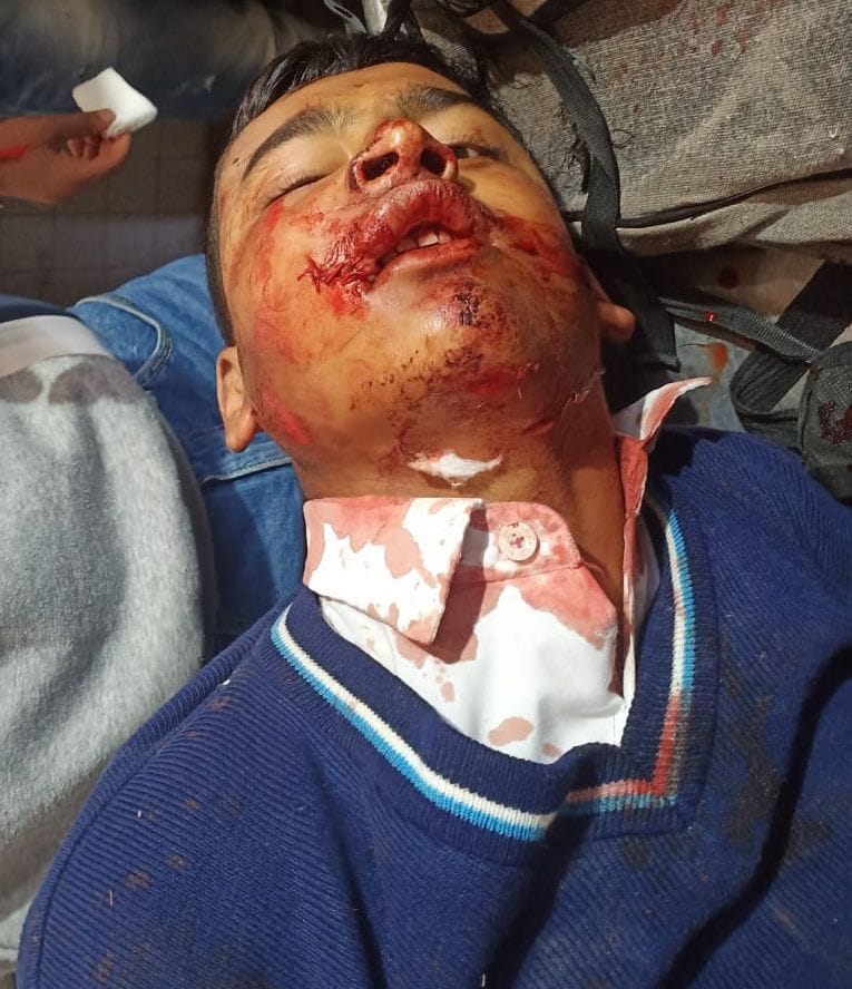 Student injured after being hit by car, higher center referred